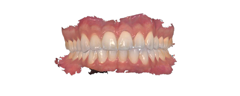 A conventional denture