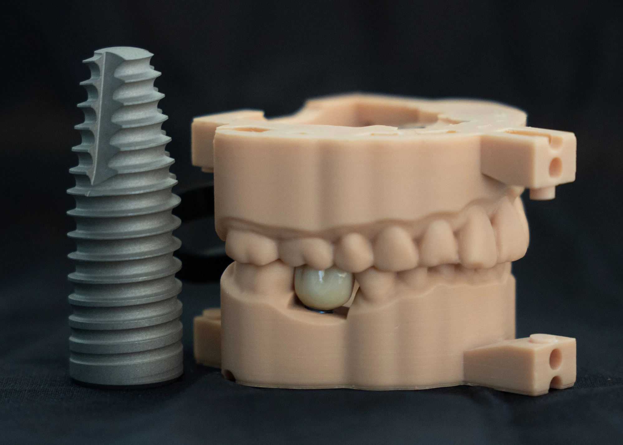An implant prosthesis example